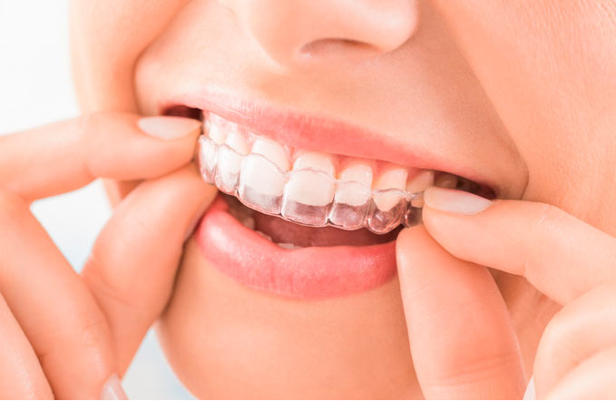 ortodoncia invisible invisalign